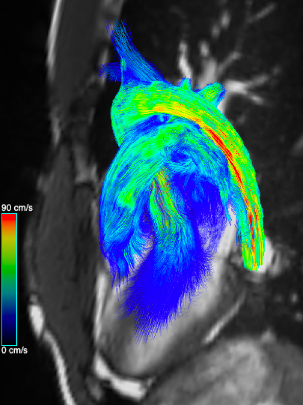 4D Flow in a cardiovascular magnetic resonance imaging