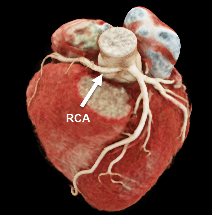 Coronary Computed Tomography Angiography